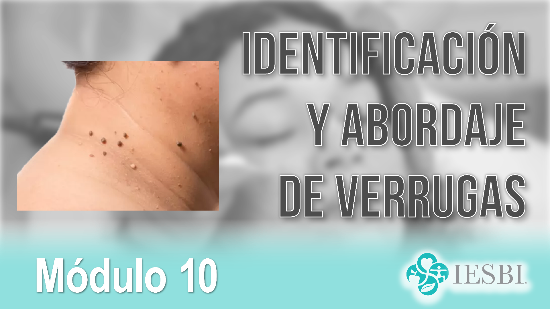 Módulo 10: Identificación y Abordaje de Verrugas