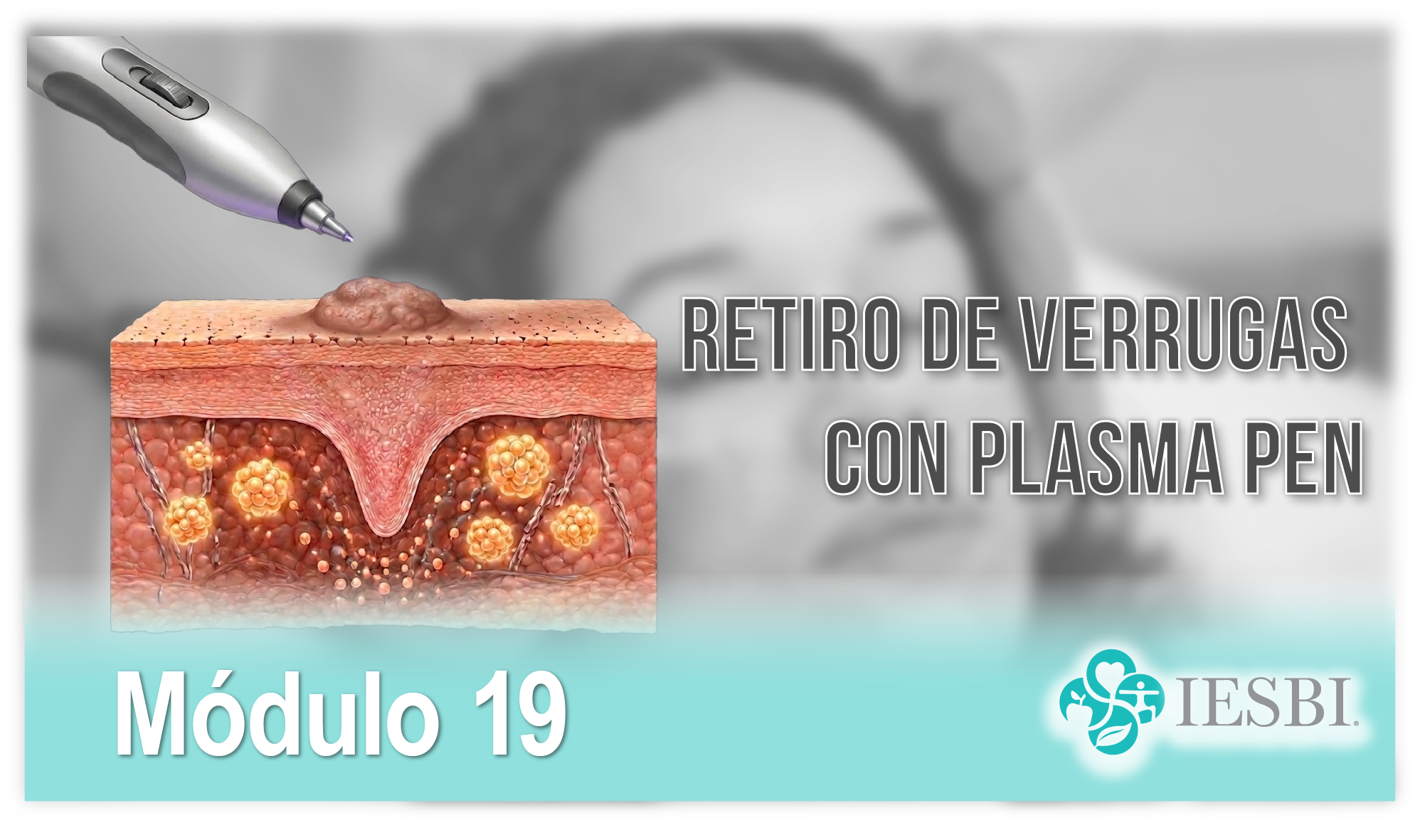 Módulo 19: Retiro de Verrugas con Plasma Pen
